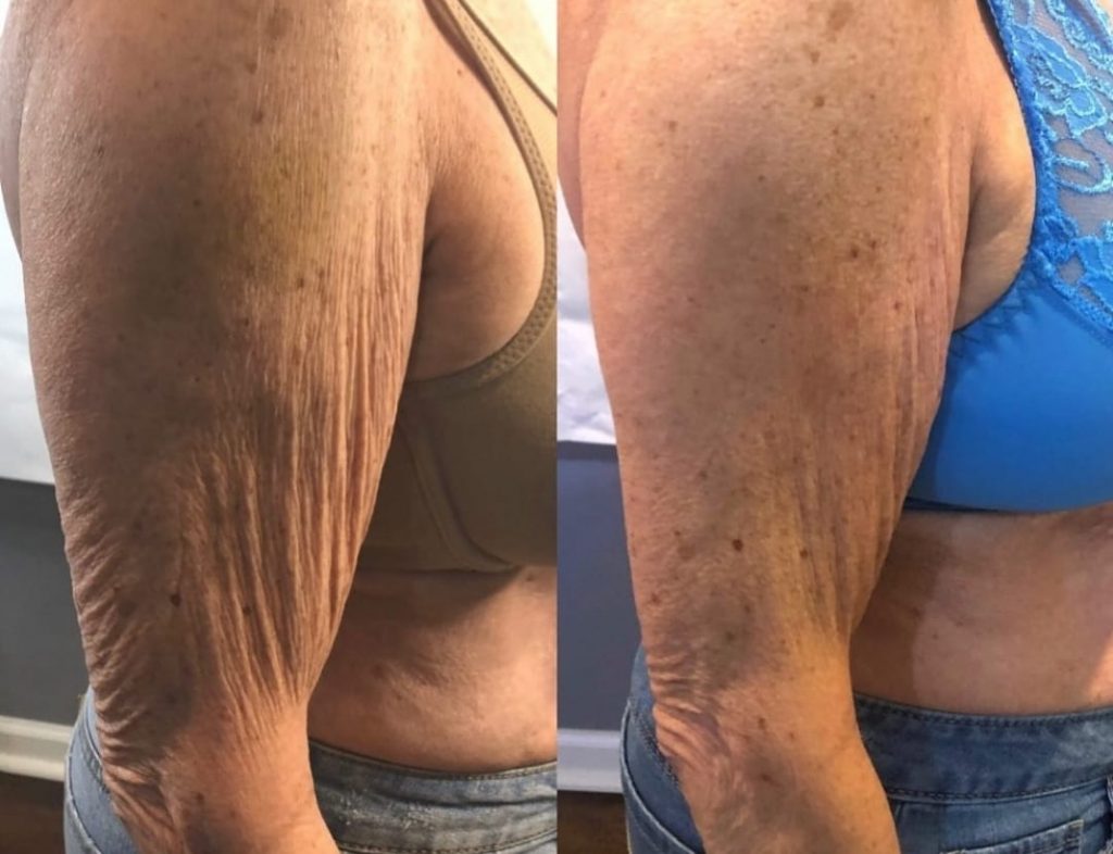toning arms