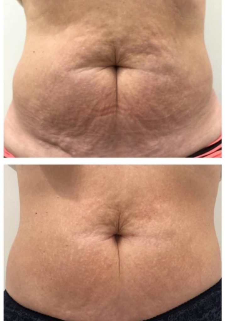toning abdomen