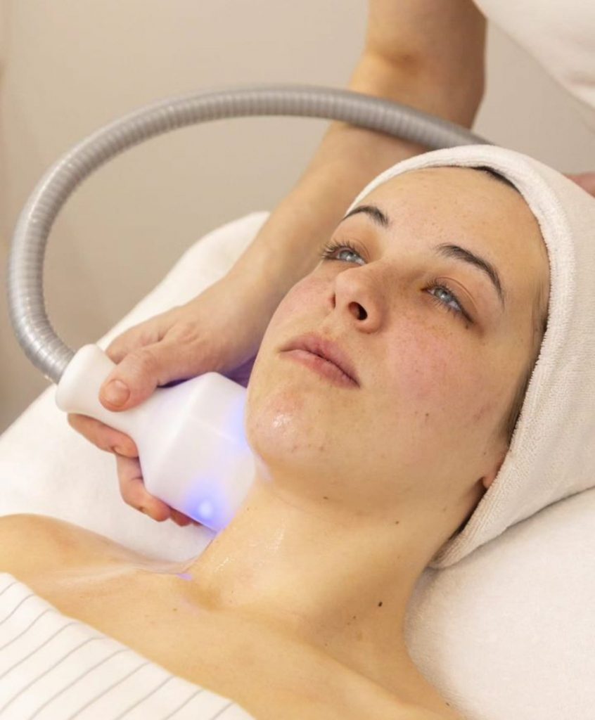 cryoskin double chin