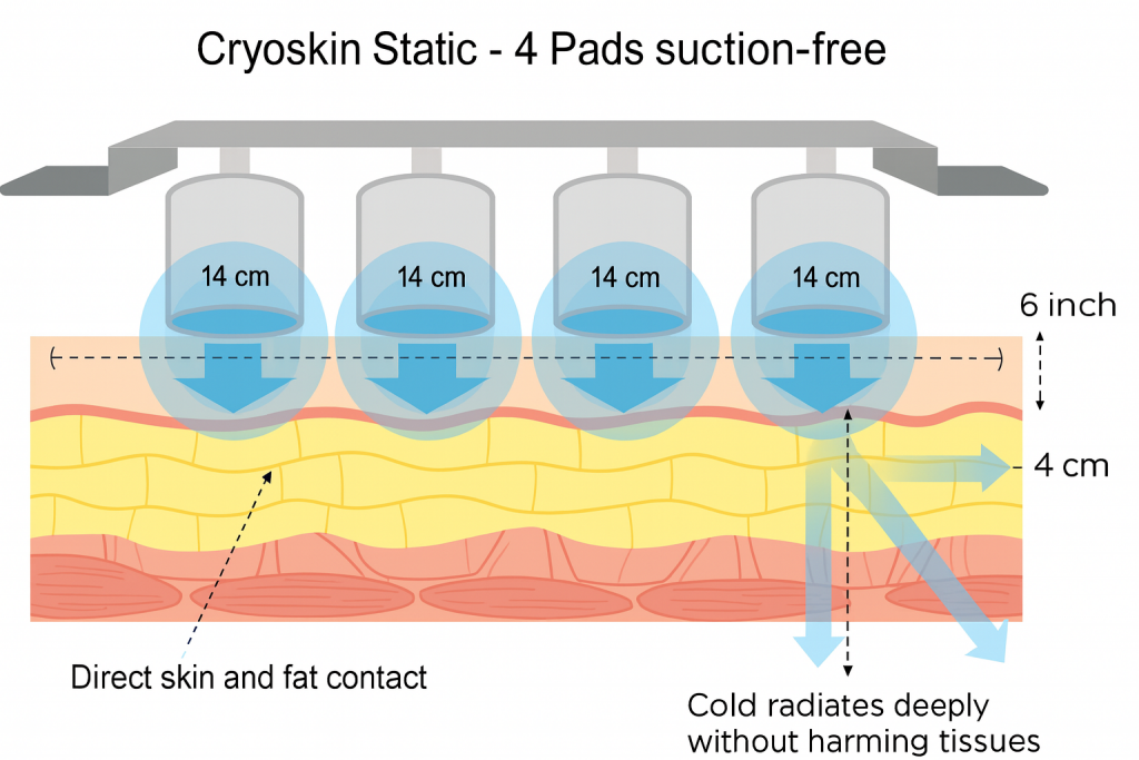 cryoskin static belt
