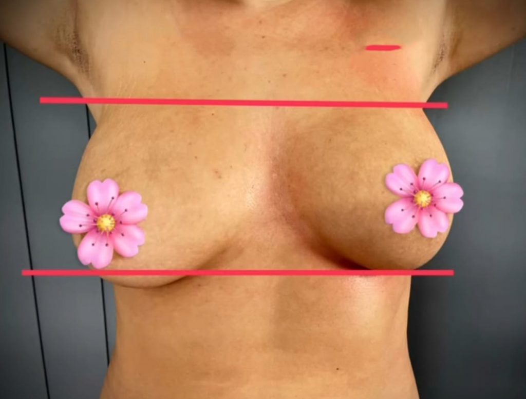 breast resukt