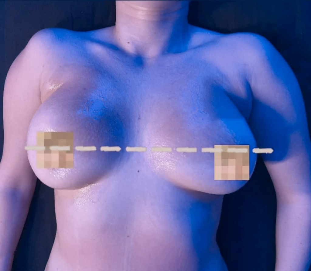 breast cryoskin 2