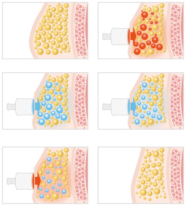 cryoslim