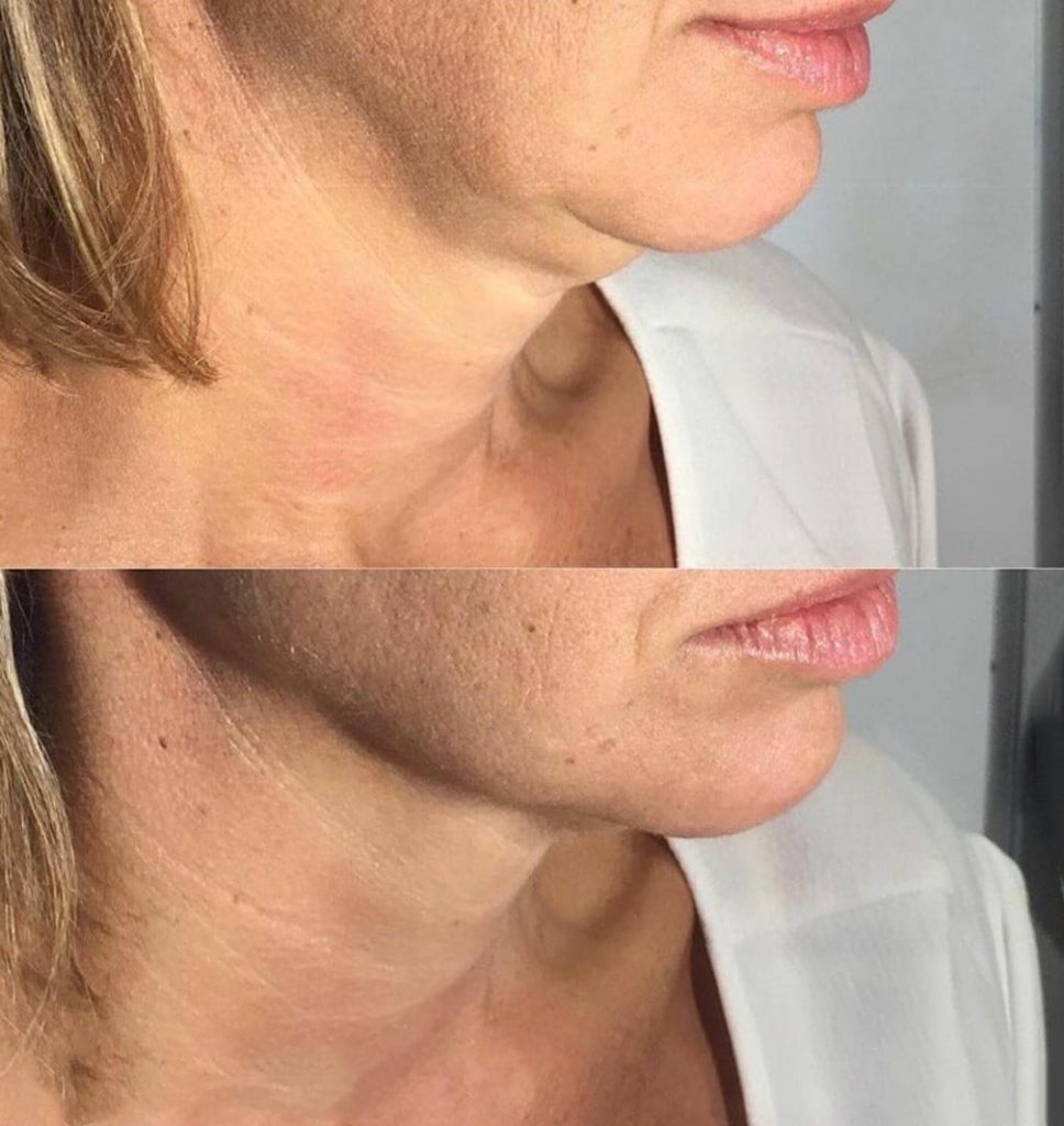 double chin cryoskin