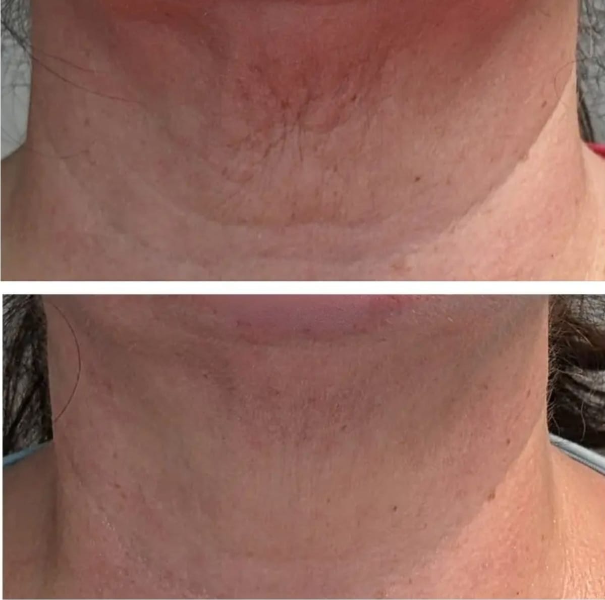 cryoskin double chin