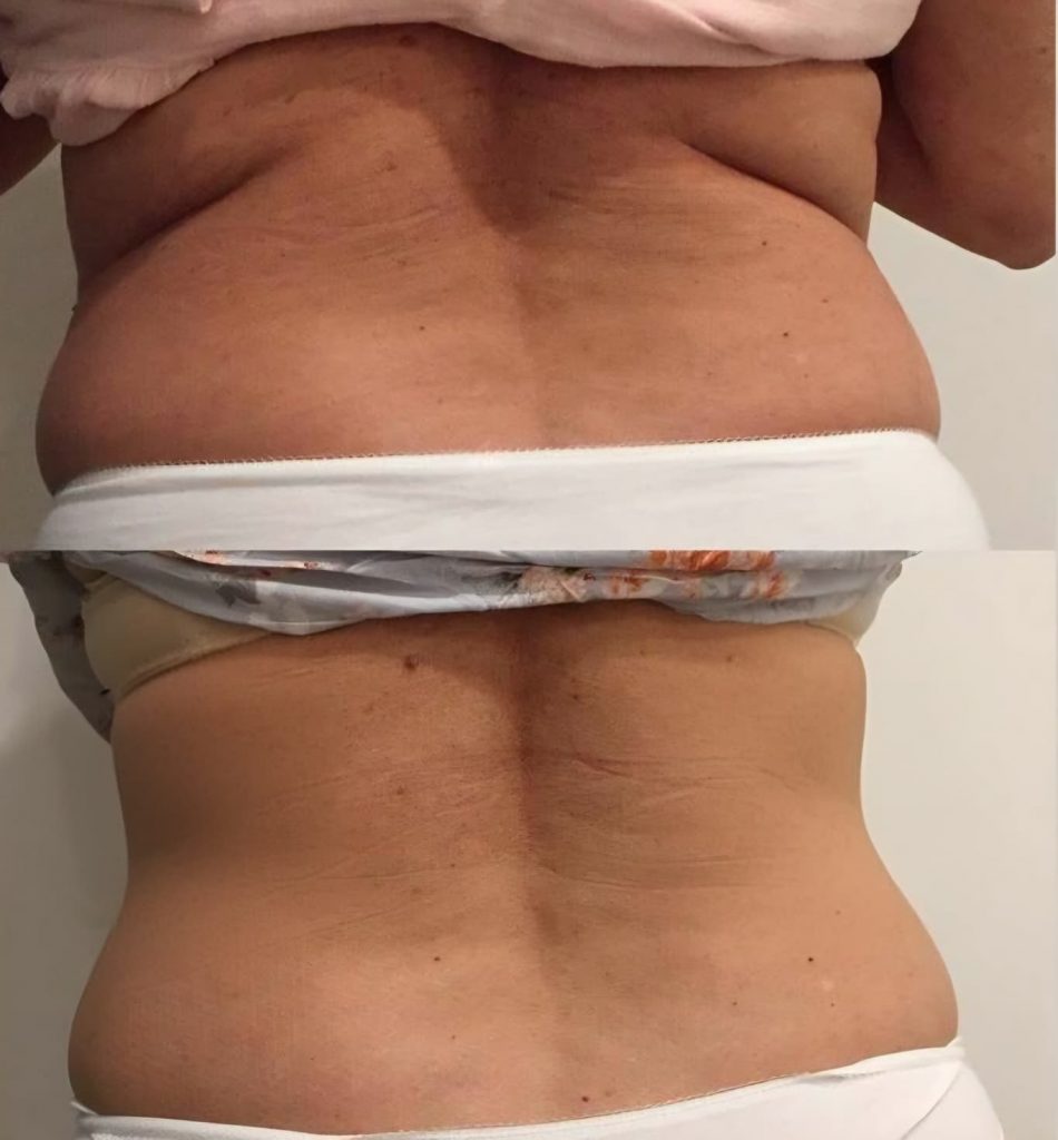 love handles results Cryoskin