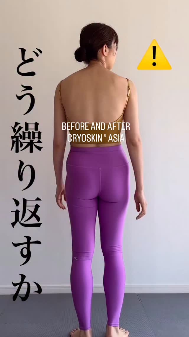 BODY CONTOURING REDEFINED — SLIMMING & TONING IN PERFECT BALANCE 

With Cryoskin, body contouring goes beyond fat reduction.
Our technology combines targeted slimming and advanced toning, alternated within a 10-session treatment package for optimal, long-lasting results.

🔹 A smart body contouring approach
By alternating slimming and toning sessions, Cryoskin reshapes the silhouette while respecting the body’s natural physiology — no suction, no trauma, no downtime.

❄️ Slimming sessions
• Target stubborn localized fat
• Reduce body volume
• Sculpt key areas (abdomen, waist, thighs, arms, flanks)

⚡ Toning sessions
• Firm and tighten the skin
• Improve muscle definition appearance
• Enhance skin texture and elasticity

Why the 10-session package works
✔️ Progressive fat reduction
✔️ Visible body reshaping
✔️ Firmer, more toned skin
✔️ Harmonized silhouette
✔️ Comfortable treatments with fast results

Already trusted by premium clinics, spas and aesthetic centers worldwide, Cryoskin body contouring delivers measurable results and high client satisfaction.

📩 More information

contact@cryoskinparis.com
🌐 www.cryoskin-international.com

🚀 We are actively looking for:
• Distributors worldwide
• Influencers & pilot customers to support our international growth

#Cryoskin #BodyContouring #Slimming #Toning #FatReduction SkinTightening NoSuction AestheticTechnology 10SessionPackage DistributorsWanted InfluencersWanted