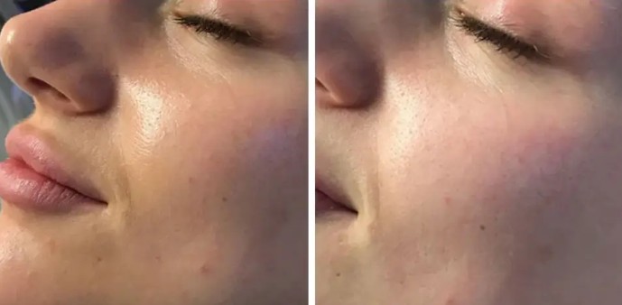 before after derma