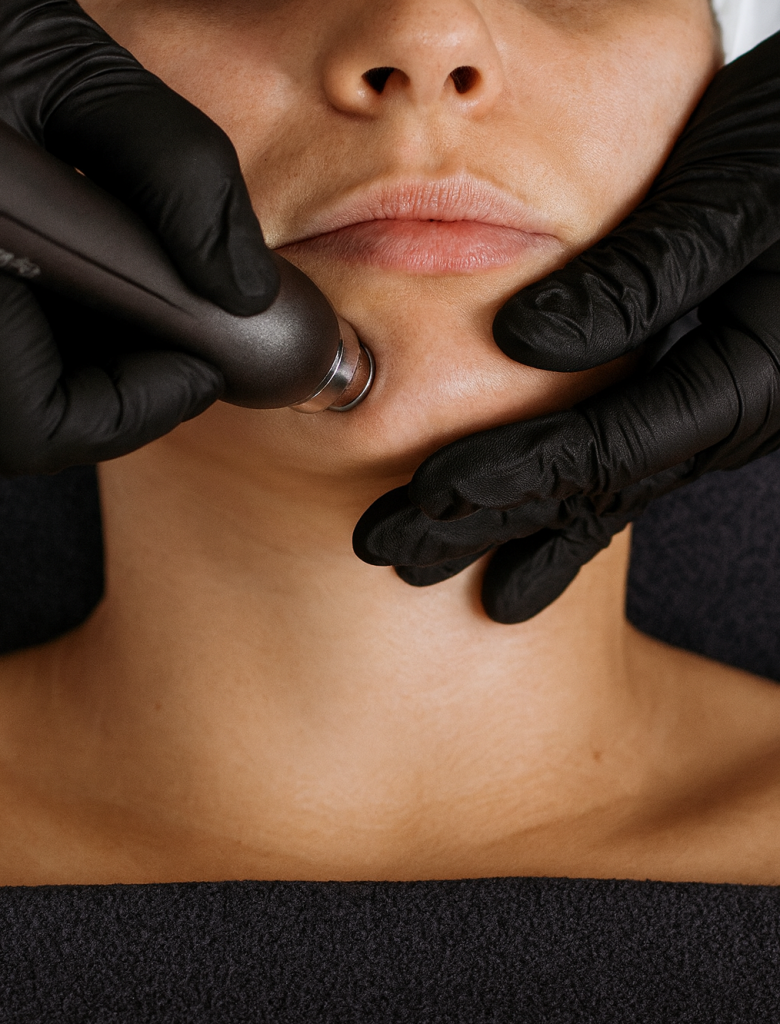eve site dermabrasion